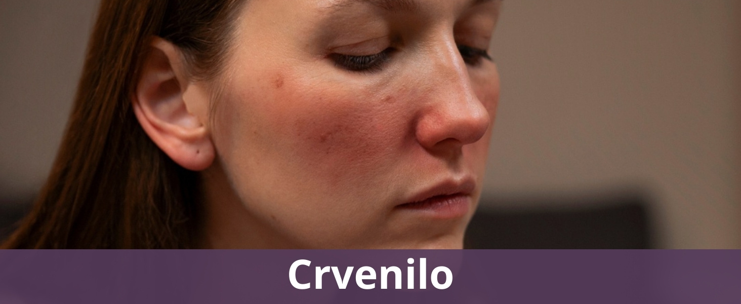 Crvenilo