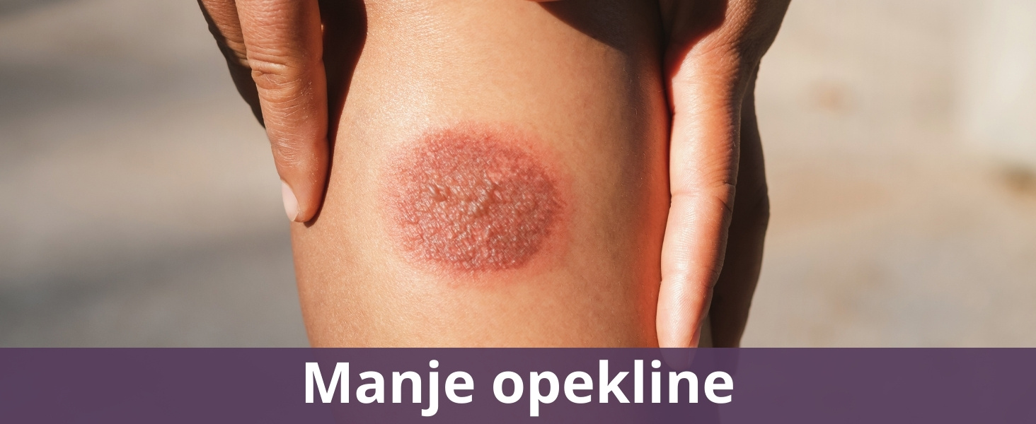 Manje opekline