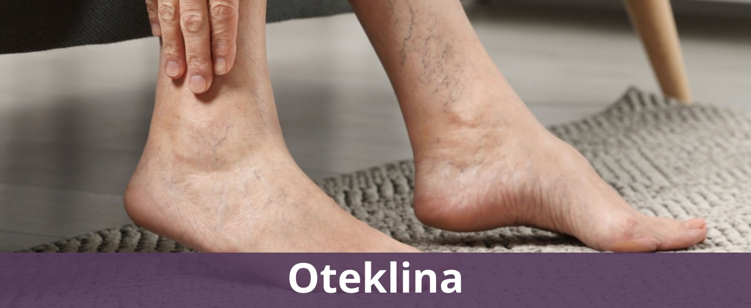 Oteklina