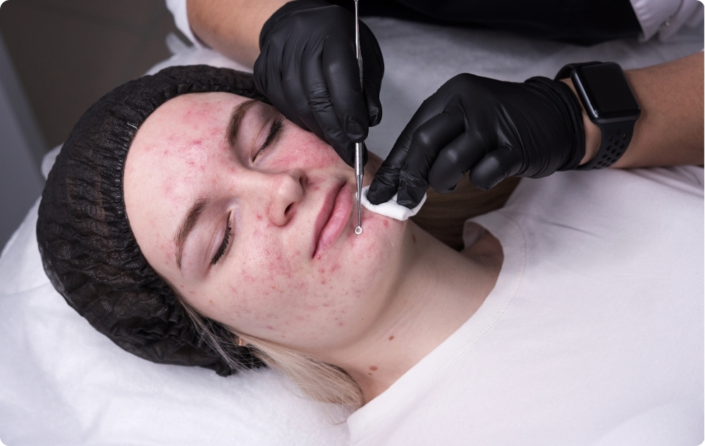 Profesionalni dermatološki zahvati